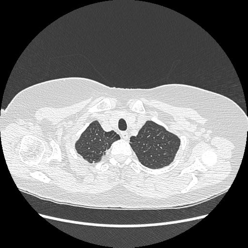 Adenocarcinoma in situ of lung (Radiopaedia 38685-40829 B 28).png