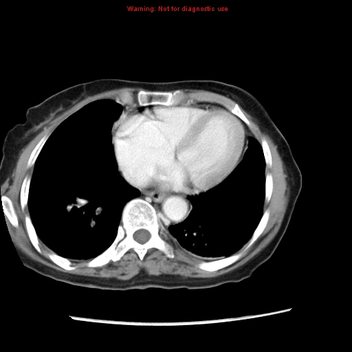 File:Adenocarcinoma of the colon (Radiopaedia 8191-9039 Axial liver window 4).jpg