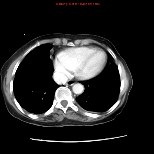 Adenocarcinoma of the colon (Radiopaedia 8191-9039 Axial liver window 8).jpg