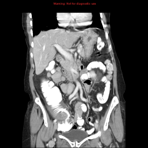 File:Adenocarcinoma of the colon (Radiopaedia 8191-9039 Coronal liver window 20).jpg
