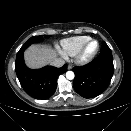 Adenocarcinoma of the lung (Radiopaedia 59871-67325 Axial C+ arterial phase 73).jpg