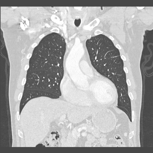 Adenocarcinoma of the lung (Radiopaedia 59871-67325 Coronal lung window 18).jpg