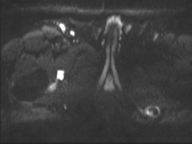 Adenocarcioma of rectum- T1 lesion (Radiopaedia 36921-38546 Axial DWI 2).png