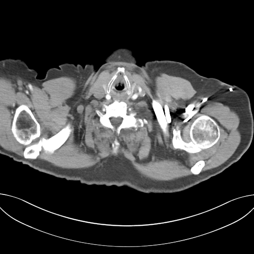 Adenocarcioma of rectum- T1 lesion (Radiopaedia 36921-38547 Axial C+ arterial phase 2).png