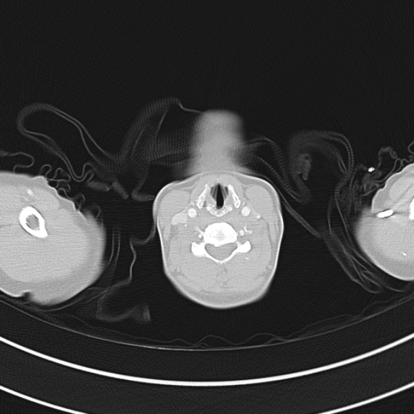 Adenocystic carcinoma of the trachea (Radiopaedia 47677-52525 Axial lung window 20).jpg