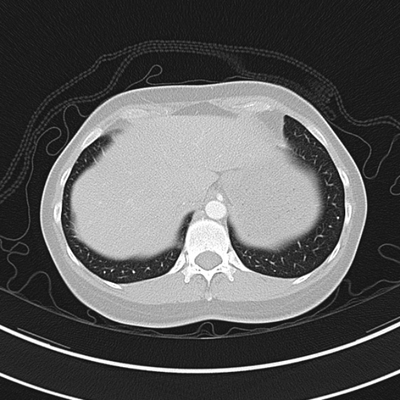 Adenocystic carcinoma of the trachea (Radiopaedia 47677-52525 Axial lung window 73).jpg