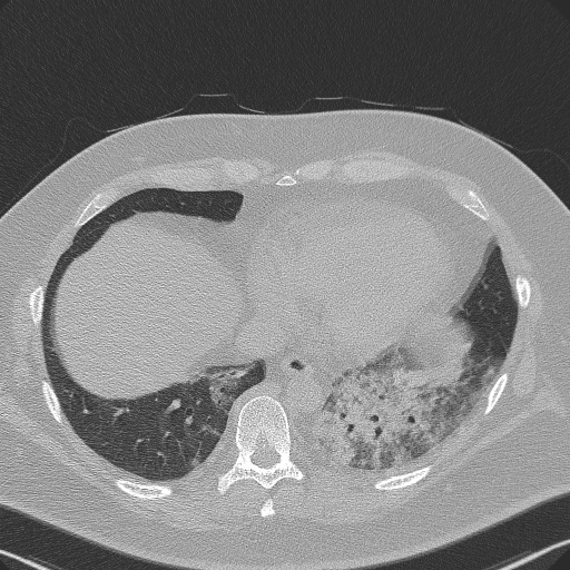 Adenoid cystic carcinoma of the trachea (Radiopaedia 49042-54137 Axial lung window 264).jpg
