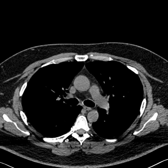 File:Adenoid cystic carcinoma of the trachea (Radiopaedia 49042-54137 Axial non-contrast 136).jpg