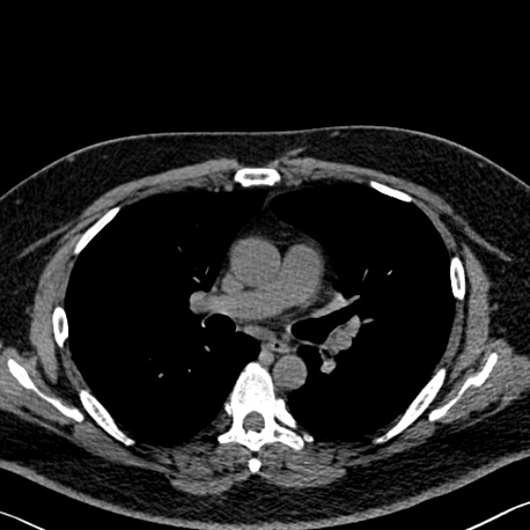 Adenoid cystic carcinoma of the trachea (Radiopaedia 49042-54137 Axial non-contrast 156).jpg