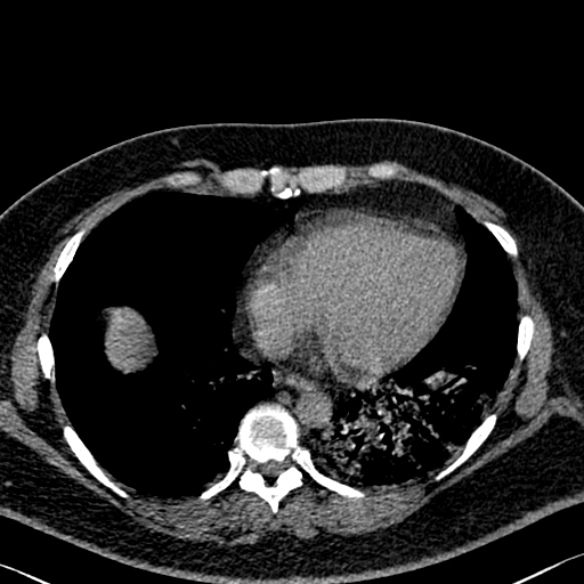 Adenoid cystic carcinoma of the trachea (Radiopaedia 49042-54137 Axial non-contrast 243).jpg