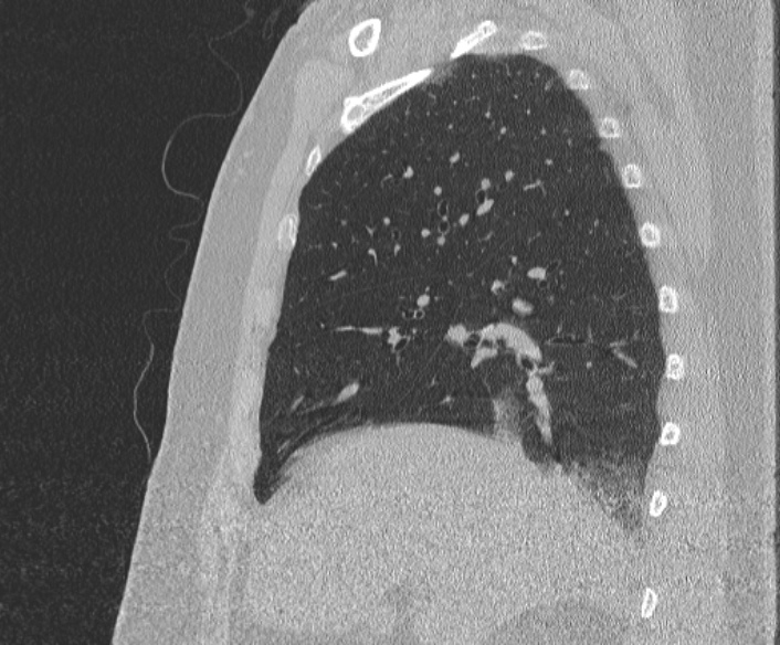 Adenoid cystic carcinoma of the trachea (Radiopaedia 49042-54137 Sagittal lung window 152).jpg