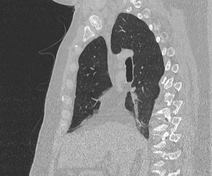 Adenoid cystic carcinoma of the trachea (Radiopaedia 49042-54137 Sagittal lung window 200).jpg