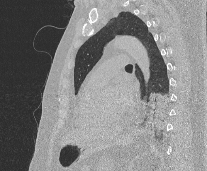Adenoid cystic carcinoma of the trachea (Radiopaedia 49042-54137 Sagittal lung window 284).jpg