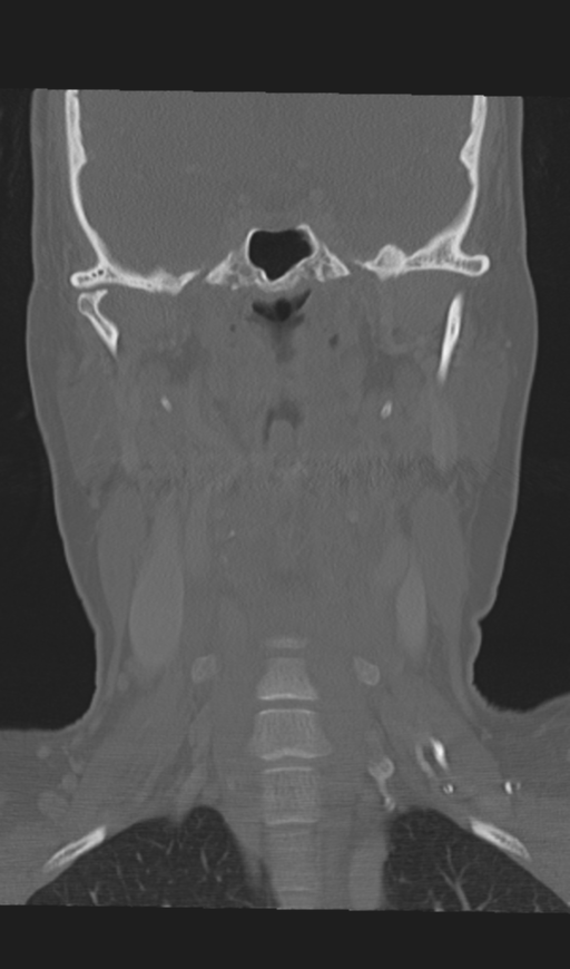 Adenoid cystic tumor of palate (Radiopaedia 46980-51518 Coronal bone window 36).png