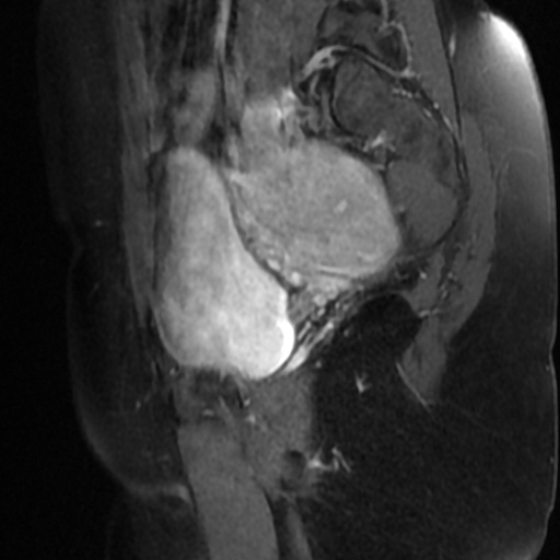 File:Adenoma malignum of cervix (Radiopaedia 66441-75705 Sagittal T1 C+ fat sat 4).jpg