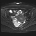File:Adenomyosis and endometriotic cysts (Radiopaedia 82300-96367 Axial DWI 11).jpg