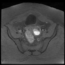 File:Adenomyosis within a didelphys uterus (Radiopaedia 70175-80215 Axial T1 fat sat 22).jpg