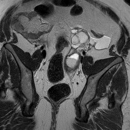 File:Adenomyosis within a didelphys uterus (Radiopaedia 70175-80215 Coronal T2 22).jpg