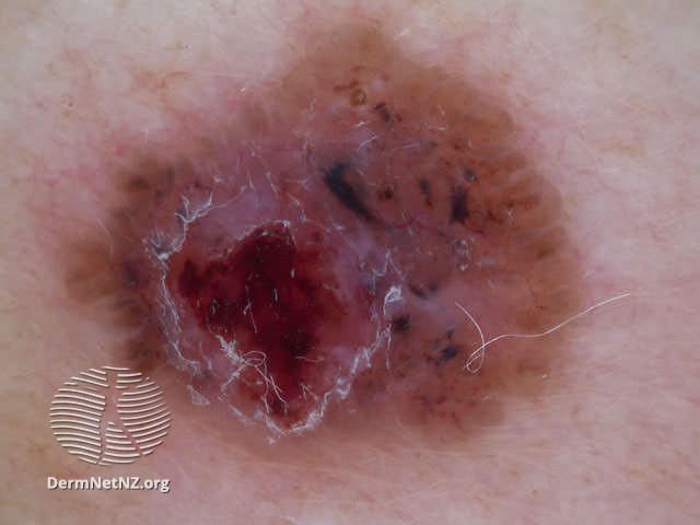 File:Adherent fibre, leaf-like structures and serpentine vessels in pigmented basal cell carcinoma dermoscopy (DermNet NZ doctors-dermoscopy-course-images-pigt-bcc).jpg