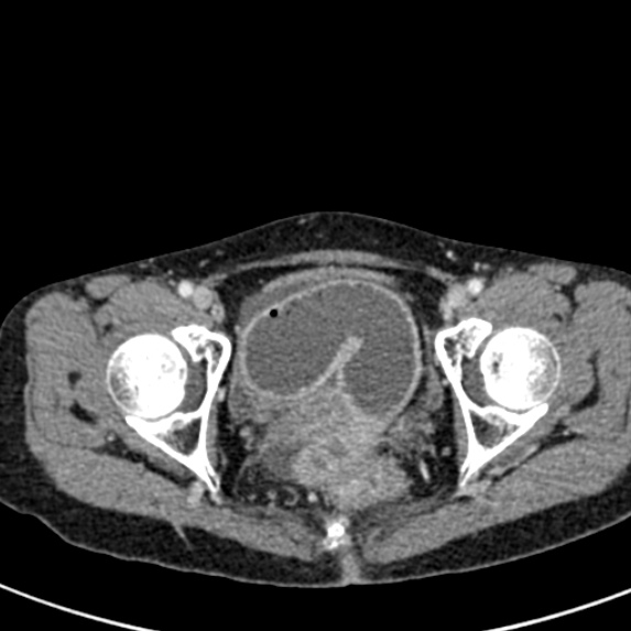 File:Adhesional small bowel obstruction (Radiopaedia 48397-53305 Axial C+ portal venous phase 87).jpg