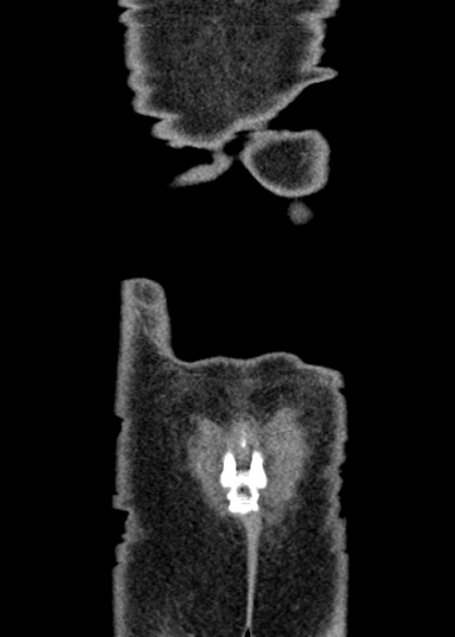 Adhesional small bowel obstruction (Radiopaedia 48397-53305 Coronal C+ portal venous phase 347).jpg
