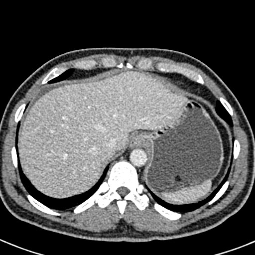 Adhesional small bowel obstruction (Radiopaedia 58900-66131 Axial C+ portal venous phase 7).jpg
