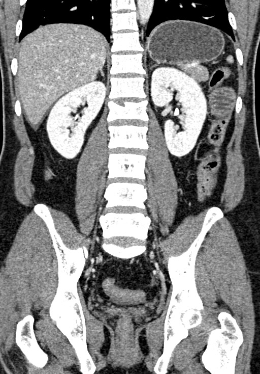 Adhesional small bowel obstruction (Radiopaedia 58900-66131 Coronal C+ portal venous phase 172).jpg