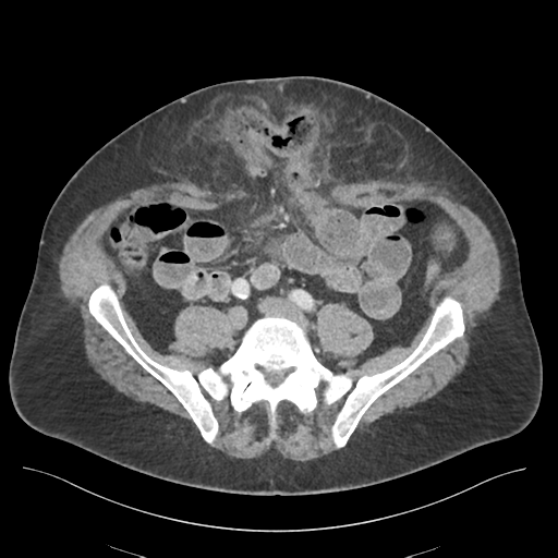 Adhesions within abdominal wall hernia (Radiopaedia 58283-65394 Axial C+ portal venous phase 57).png