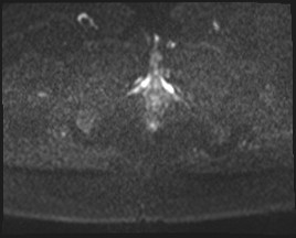 Adnexal multilocular cyst (O-RADS US 3- O-RADS MRI 3) (Radiopaedia 87426-103754 Axial DWI 57).jpg