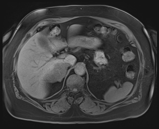 Adrenal cortical carcinoma (Radiopaedia 64017-72770 Axial T1 fat sat 23).jpg