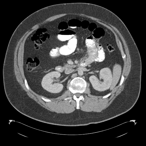 Adrenal cyst (Radiopaedia 45625-49776 Axial C+ portal venous phase 40).png