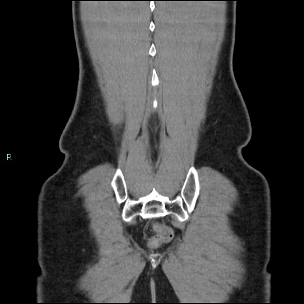 Adrenal cystic lymphangioma (Radiopaedia 83161-97534 Coronal C+ portal venous phase 71).jpg