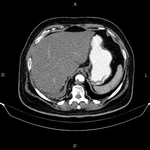Adrenal hemorrhage (Radiopaedia 62622-70916 Axial C+ arterial phase 57).jpg
