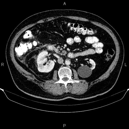 Adrenal hemorrhage (Radiopaedia 62622-70916 Axial C+ portal venous phase 86).jpg