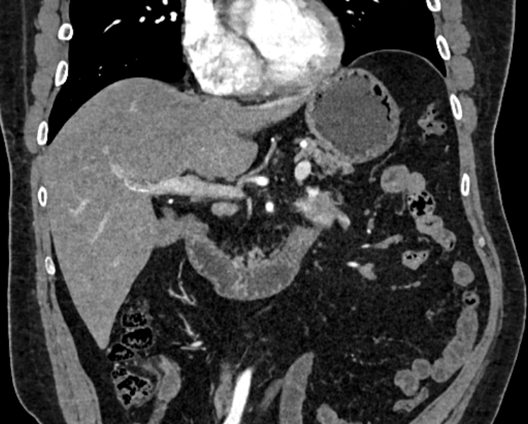 Adrenal metastases (Radiopaedia 73082-83791 Coronal C+ arterial phase 10).jpg
