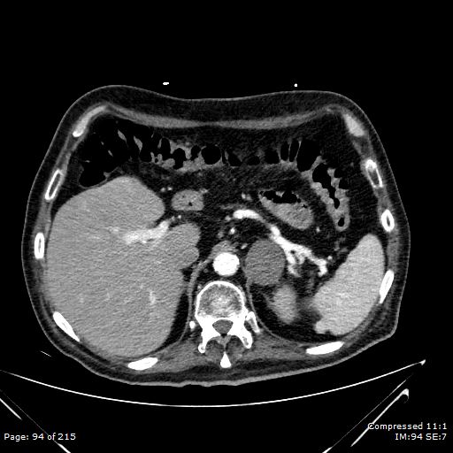 Adrenal metastasis (Radiopaedia 78425-91079 Axial C+ arterial phase 24).jpg