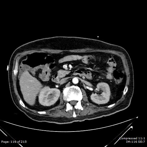 Adrenal metastasis (Radiopaedia 78425-91079 Axial C+ arterial phase 46).jpg