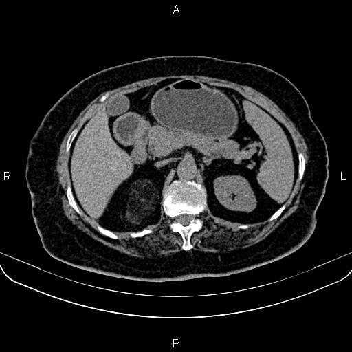 Adrenal myelolipoma (Radiopaedia 82742-96986 Axial non-contrast 49).jpg