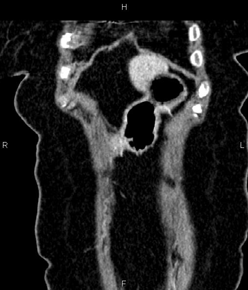 Adrenal myelolipoma (Radiopaedia 82742-96986 Coronal renal cortical phase 13).jpg