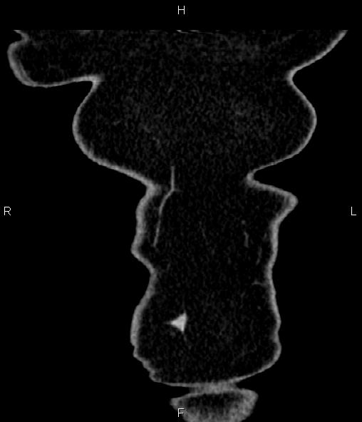 File:Adrenal myelolipoma (Radiopaedia 82742-96986 Coronal renal cortical phase 4).jpg