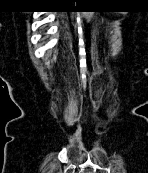 Adrenal myelolipoma (Radiopaedia 82742-96986 Coronal renal cortical phase 71).jpg
