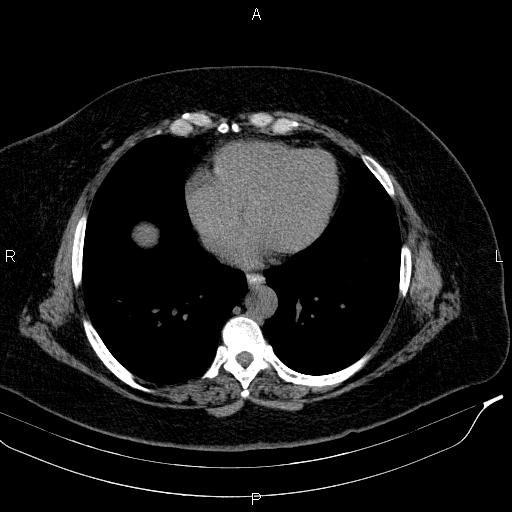 File:Adrenal myelolipoma (Radiopaedia 84319-99617 Axial With oral contrast 13).jpg