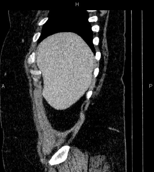 Adrenal myelolipoma (Radiopaedia 84319-99617 Sagittal renal cortical phase 9).jpg