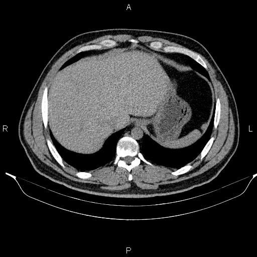 Adrenal myelolipoma (Radiopaedia 84321-99619 Axial non-contrast 18).jpg
