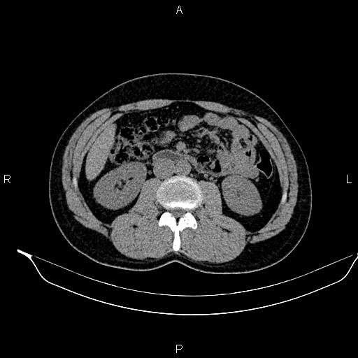 Adrenal myelolipoma (Radiopaedia 87794-104246 Axial non-contrast 52).jpg