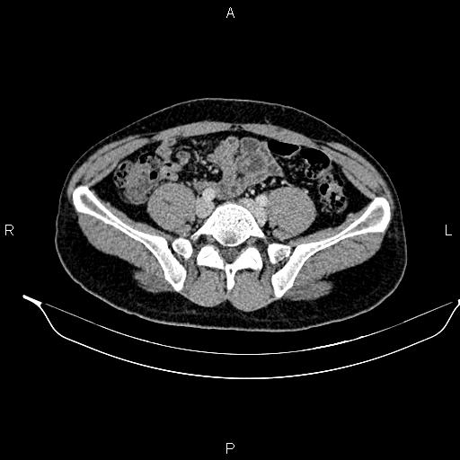 Adrenal myelolipoma (Radiopaedia 87794-104246 Axial renal cortical phase 75).jpg