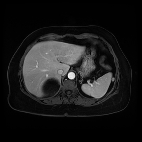 Adrenal myelolipoma - MRI (Radiopaedia 83249-97646 T1 fat sat arterial phase 16).jpg