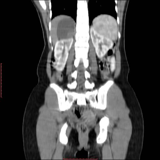 File:Adrenal pseudocyst (Radiopaedia 44419-48073 Coronal C+ portal venous phase 8).jpg