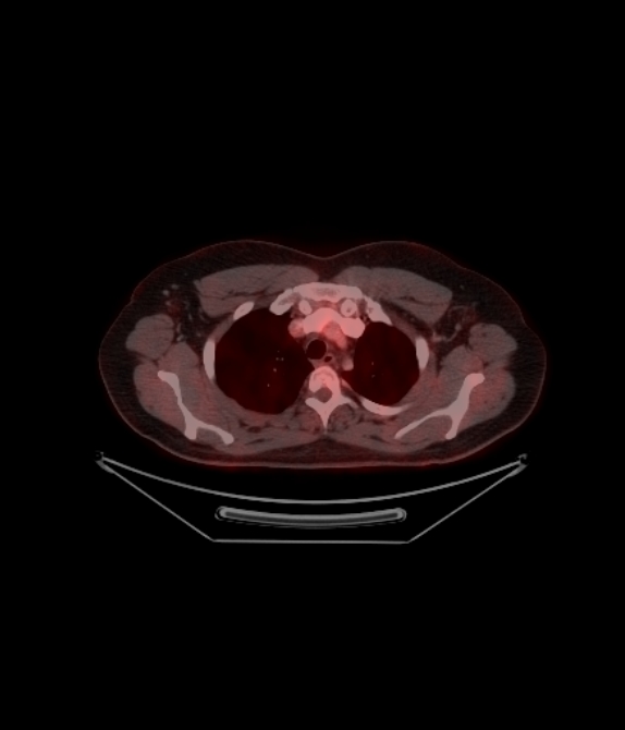 Adrenocortical carcinoma (Radiopaedia 80134-93440 ِAxial 96).jpg