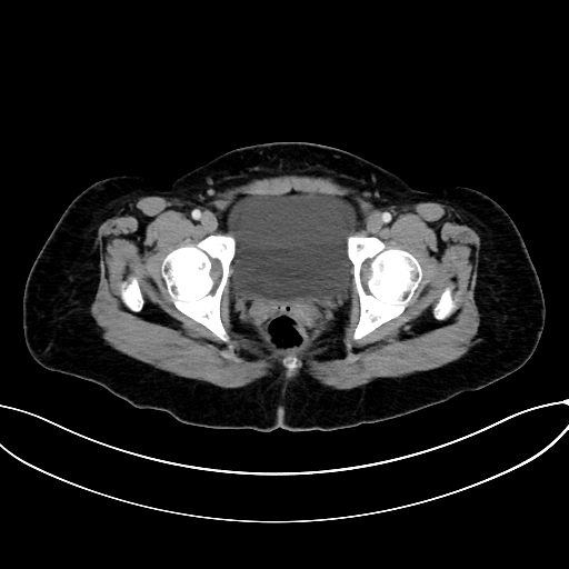 Adrenocortical carcinoma (Radiopaedia 87281-103569 Axial C+ portal venous phase 83).jpg